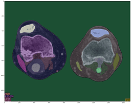 CT Scan Segmentation