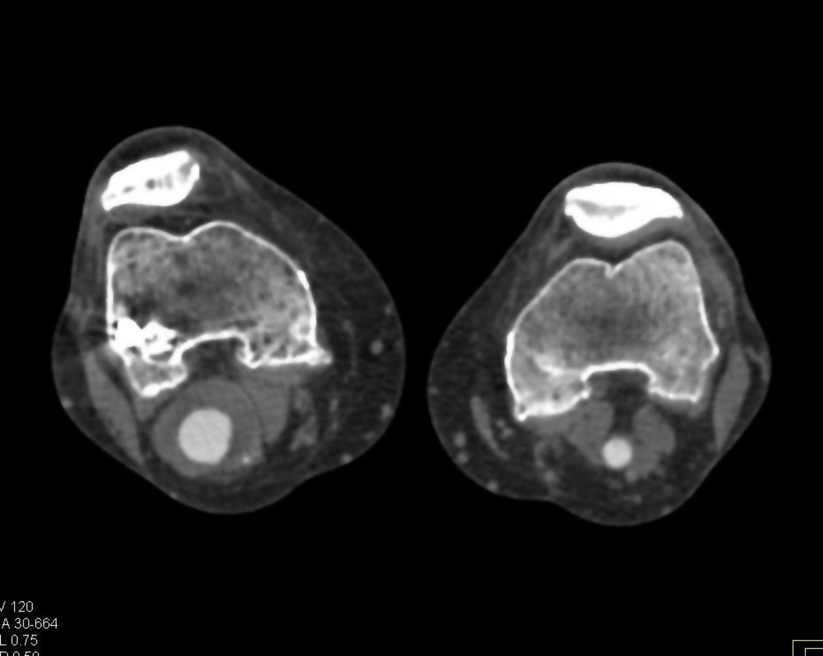 Bilateral Denoising - 317947